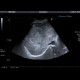 Liver hemangioma, huge: US - Ultrasound